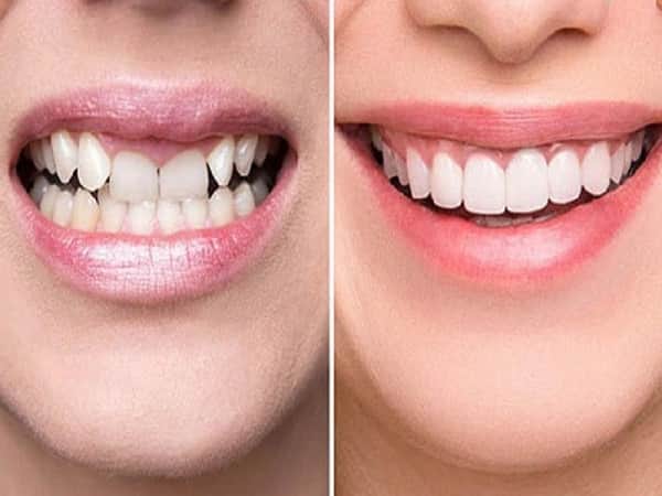 Cải thiện hàm răng: Niềng răng